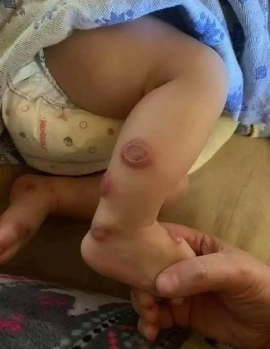 ALERT: These are the Signs of Sweet Syndrome