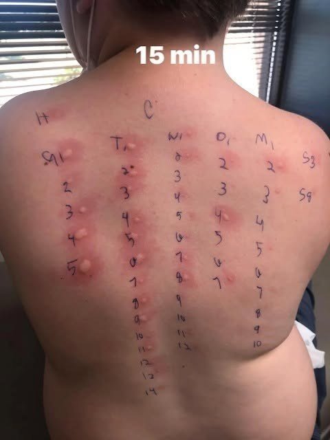 My Poor Baby! Understanding His Allergy Test Results After 15 Minutes