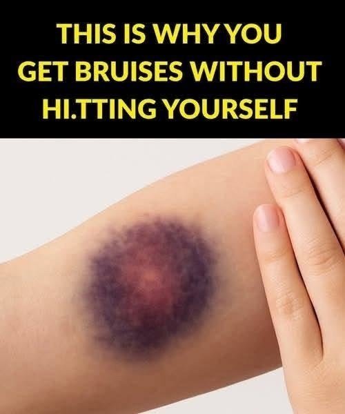 Why do bruises appear without being hi.t?